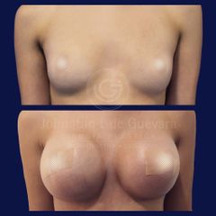 Mamoplastia de aumento - Doctor Guevara