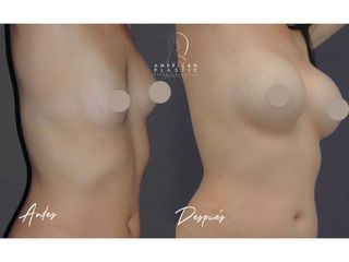 Mamoplastia de aumento