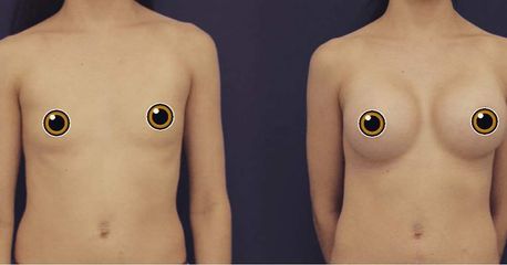 Mamoplastia de aumento - American Plastic