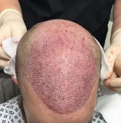 Haartransplantation - Prof. Dr. med. Nektarios Sinis