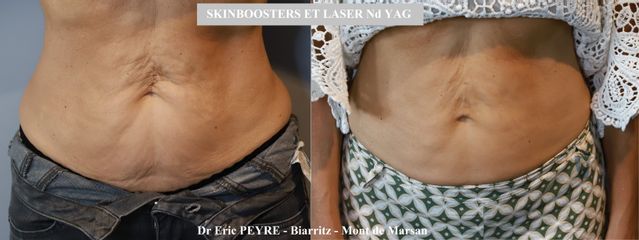 Dr Eric Peyre Lifting sans chirurgie