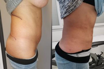 Liposuccion - Dr Louay El Ayoubi