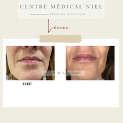 Augmentation des lèvres - Dr Catherine de Goursac