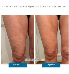Traitement anti-cellulite - Dr Catherine de Goursac