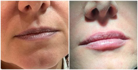 Aumentation des lèvres - Dr Catherine de Goursac