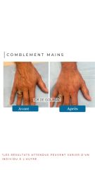 Comblement Mains - Dr De Goursac