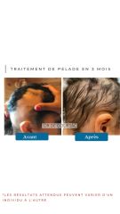 Traitement de Pelade - Dr De Goursac