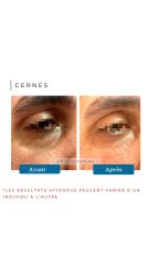 Cernes - Dr De Goursac