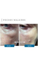 Poches malaires Dr De Goursac