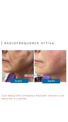 Radiofréquence Attiva - Dr Catherine de Goursac