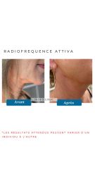 Radiofréquence Attiva - Dr De Goursac