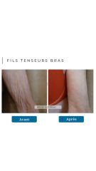 Fils Tenseurs Bras - Dr De Goursac