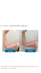 Fils Tenseurs Bras - Dr De Goursac