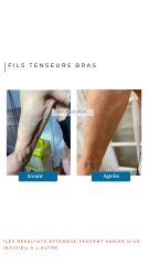 Fils Tenseurs Bras - Dr De Goursac