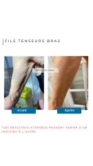 Fils Tenseurs Bras - Dr De Goursac