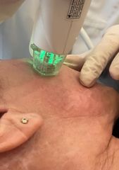 Radiofréquence microneedlée - Dr De Goursac