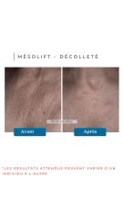 Mésolift - Dr De Goursac