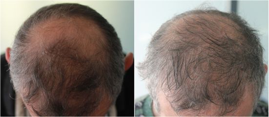 Implants capillaires - Méthode Macro Greffe De Cheveux