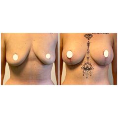 Augmentation mammaire - Dr Franck Faramarz