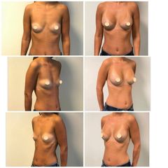 Augmentation mammaire - Dr Franck Faramarz