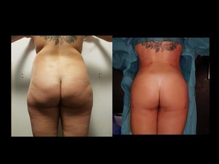 Avant après Liposculture