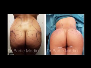 Avant après Liposculture