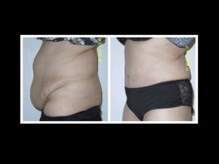 Avant après Abdominoplastie