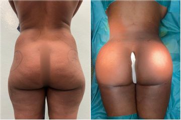 Chirurgie des fesses - Dr Behzad Badie Modiri