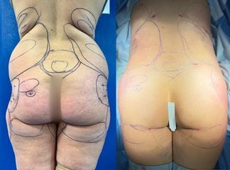 Liposuccion - Dr Behzad Badie Modiri