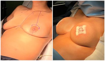 Augmentation mammaire  - Dr Behzad Badie Modiri