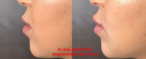 Légère augmentation des lèvres - Dr Eric Bonafos