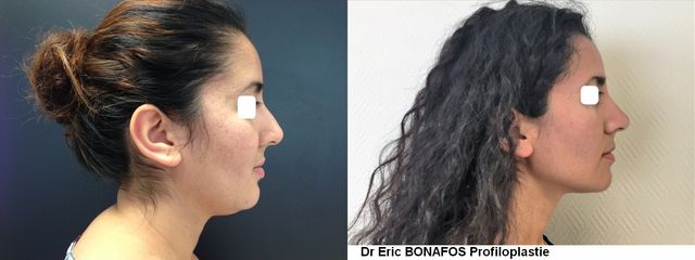 Profiloplastie - Dr Eric Bonafos