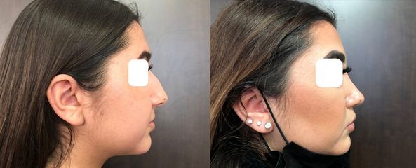 Rhinoplastie - Dr Eric Bonafos