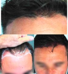 Implants capillaires - Méthode Macro Greffe De Cheveux