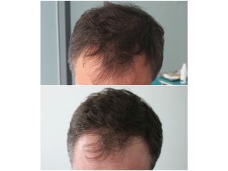Greffe de cheveux - Méthode Macro Greffe De Cheveux