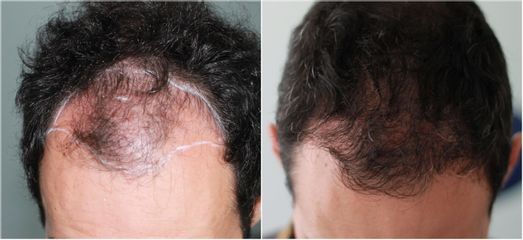 Greffe de cheveux - Méthode Macro Greffe De Cheveux