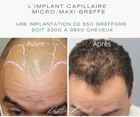 Implants capillaires - Dr Alain Berkovits