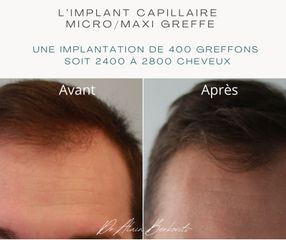 Implants capillaires - Dr Alain Berkovits