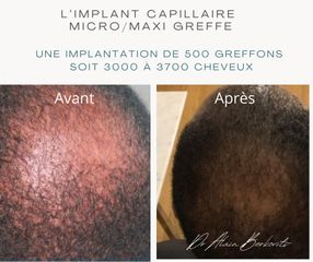 Implants capillaires - Dr Alain Berkovits