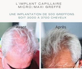 Implants capillaires - Dr Alain Berkovits