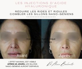 Acide hyaluronique - Dr Alain Berkovits