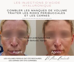 Acideo hyaluronique - Dr Alain Berkovits