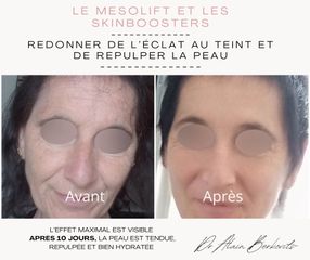 Mesolift - Dr Alain Berkovits