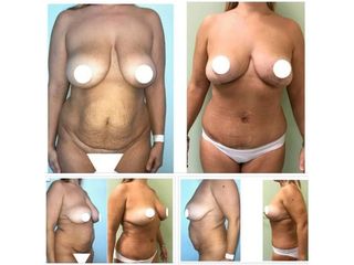 Liposcultura prima e dopo