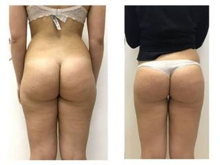 Liposuzione prima e dopo