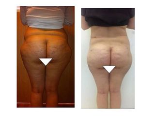Liposuzione prima e dopo