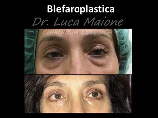 Blefaroplastica - Dott. Luca Maione