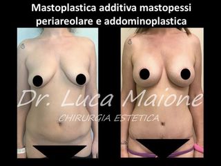 Mastoplastica additiva - Dott. Luca Maione