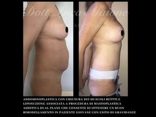 Addominoplastica - Dott. Luca Maione