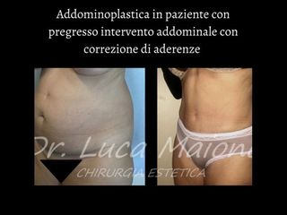 Addominoplastica - Dott. Luca Maione